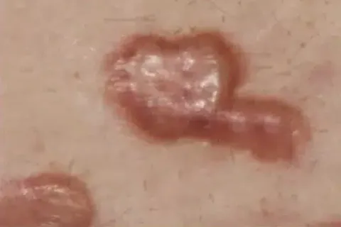 Lumpy hypertrophic and keloid scars