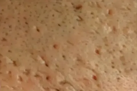 Ice pick acne scars