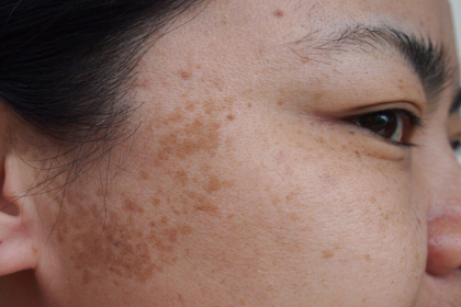 EVER HEARD OF THESE 2 EFFECTIVE MELASMA TREATMENTS?