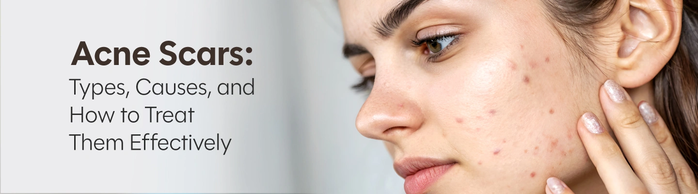 Microneedling for acne scars collagen stimulation