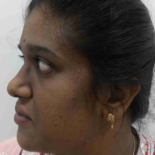 Pigmentation Treatment