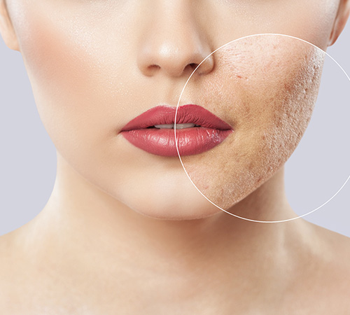 VCare’s Fractional Co2 Laser