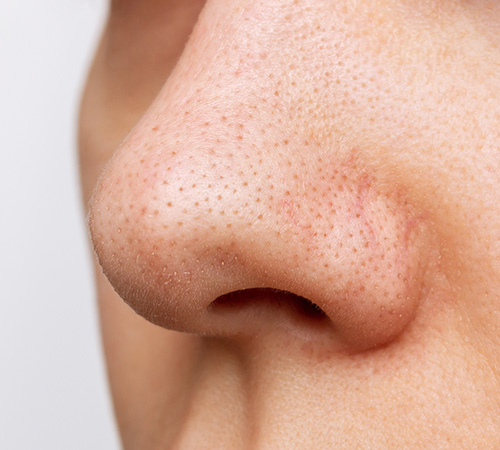 skin whitening treatment chennai