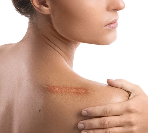 VCare’s tattoo removal